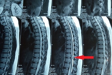 Xẻ màng tủy, bóc khối u cứu cô gái thoát nguy cơ liệt