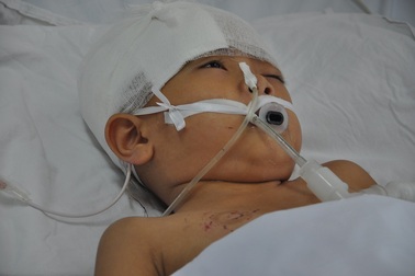 Bị chú vô tình bắn súng tự chế vào đầu, bé 6 tuổi người dân tộc Dao nguy kịch tính mạng