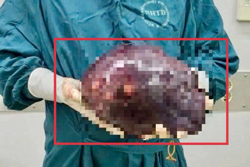 Khối u gan to như quả bóng vì chủ quan với bệnh phổ biến - 2 Khối u gan to như quả bóng vì chủ quan với bệnh phổ biến - 2