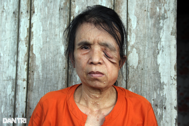 Người phụ nữ cô đơn bị căn bệnh quái ác hành hạ suốt nửa thế kỷ