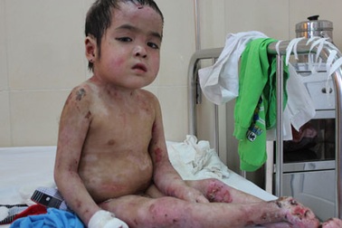 Xót thương cậu bé 5 tuổi không có ngón chân