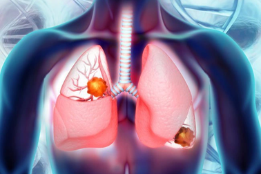 U phổi lành tính có di căn không?