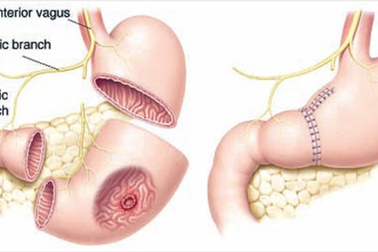 Phát sinh u sau cắt đoạn dạ dày