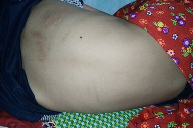 Bị mèo cào, bé trai 11 tuổi tử vong