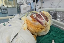 Bác sĩ kêu gọi cứu chàng trai dân tộc Mông nguy kịch vì bỏng điện