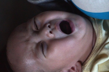 Xót xa cháu bé 6 tháng tuổi không có hậu môn kèm bệnh tim bẩm sinh