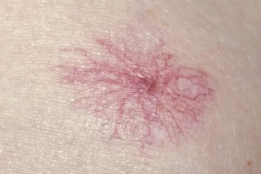 Xuất hiện loại nốt ruồi màu đỏ này cần đi khám gan ngay