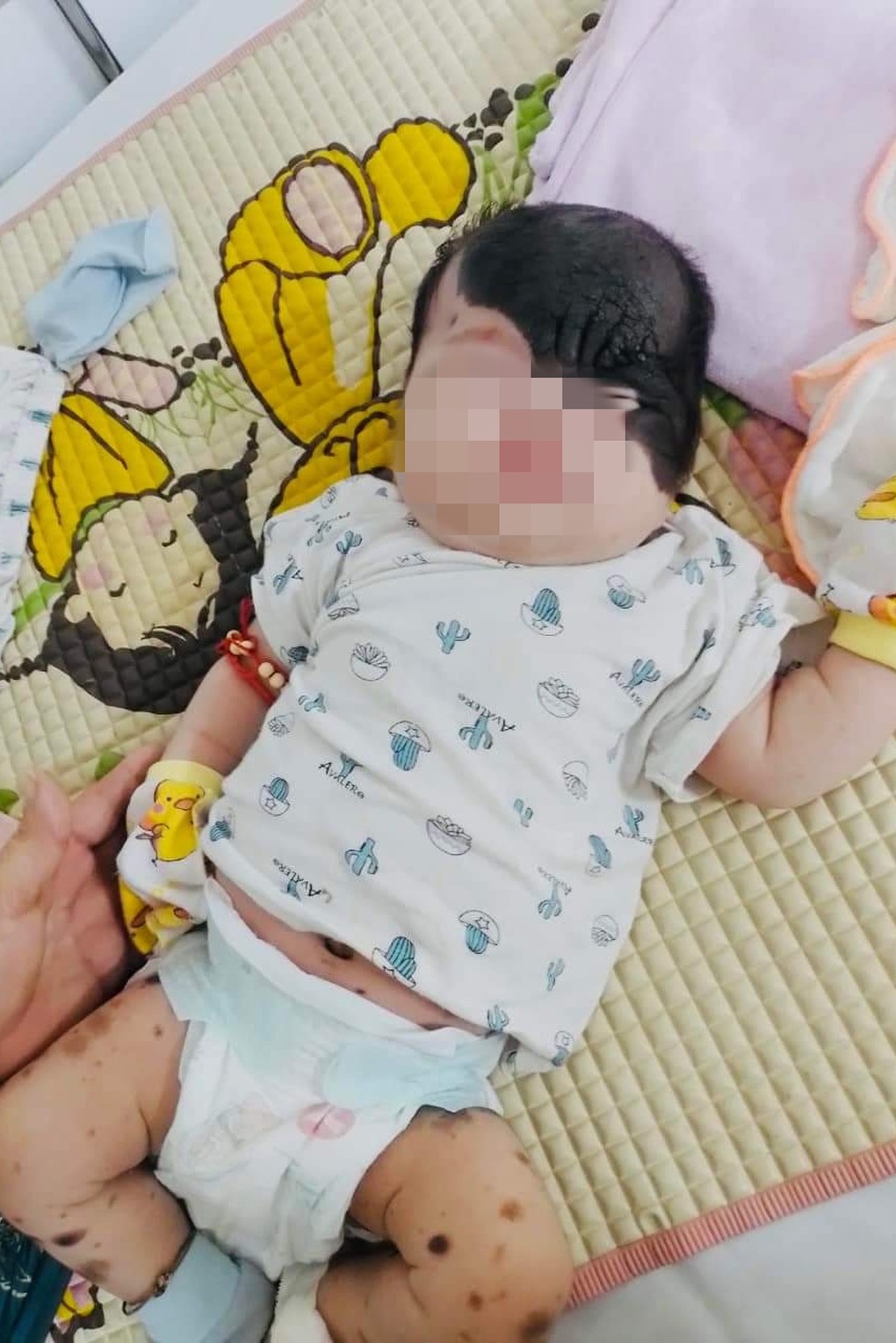 Mẹ phải điều trị tâm thần khi con gái vừa sinh đã mang gương mặt cháy đen - 1 Mẹ phải điều trị tâm thần khi con gái vừa sinh đã mang gương mặt cháy đen - 1