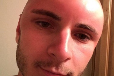 Chàng trai bị lõm đầu vì phơi nắng quá lâu