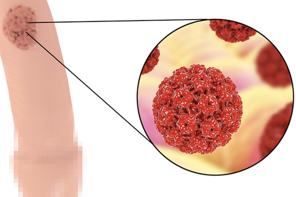 Người trẻ mắc ung thư vùng kín, vaccine có giúp điều trị bệnh? - 1 Người trẻ mắc ung thư vùng kín, vaccine có giúp điều trị bệnh? - 1