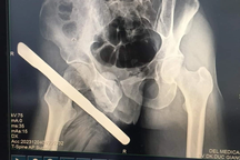 Hà Nội: Sắt đâm xuyên mông vì ngã, chàng trai trắng đêm chờ người cứu