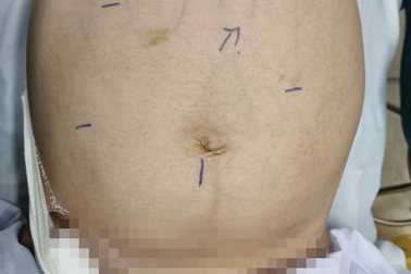 Sai lầm 8 năm trước khiến người phụ nữ đau đớn, phình bụng vì "vật thể lạ"