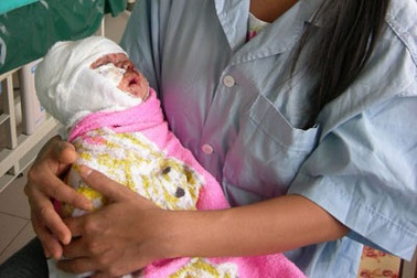 Sưởi ấm, bé trai 1 tháng tuổi rơi vào chậu than 