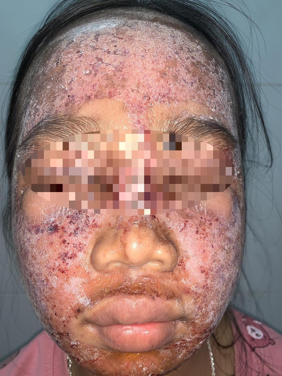Làm đẹp “siêu tốc” với lọ kem 65 nghìn, da mặt thiếu nữ sưng phù, lở loét - 1 Làm đẹp “siêu tốc” với lọ kem 65 nghìn, da mặt thiếu nữ sưng phù, lở loét - 1