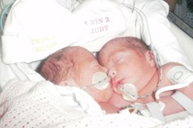 Phép màu đến với hai cô bé sinh đôi dính liền bụng