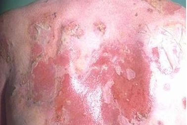 Vẩy nến toàn thân và cách điều trị