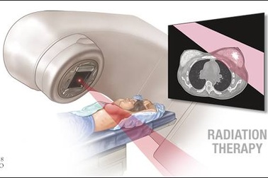 Xạ trị ngoài trong điều trị ung thư là gì?