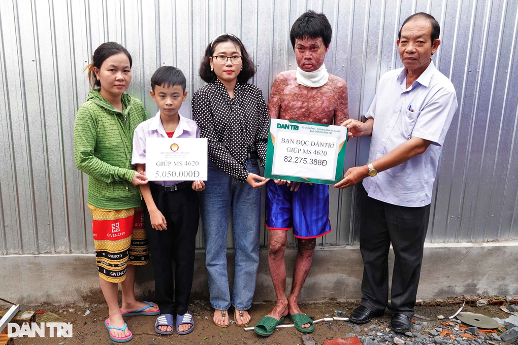 Trao hơn 87 triệu đồng tới người đàn ông bị bỏng trên 90% ở Hậu Giang - 1 Trao hơn 87 triệu đồng tới người đàn ông bị bỏng trên 90% ở Hậu Giang - 1