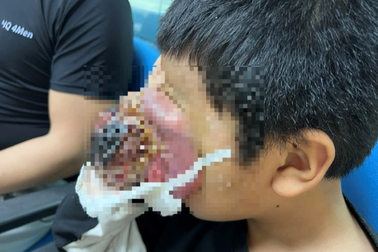 Cậu bé 4 tuổi bị "nổ" mắt, u to như quả ổi