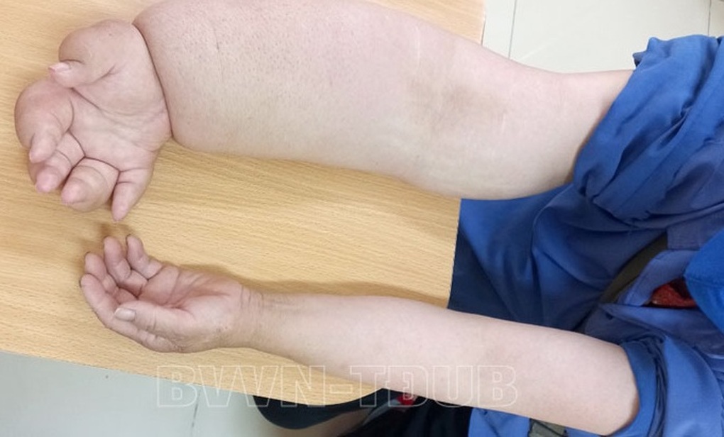 Cánh tay to gấp đôi sau điều trị ung thư vú - 1 Cánh tay to gấp đôi sau điều trị ung thư vú - 1
