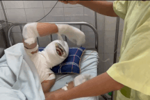Nam sinh lớp 11 bị điện cao thế giật nguy kịch, đau đớn trên giường bệnh