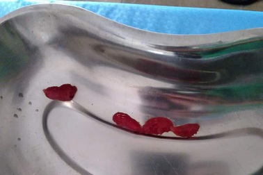 Gắp thành công 4 con sán trong dạ dày người phụ nữ