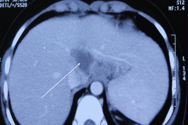 Ca lao gan trên nền bệnh Wilson “cực hiếm” xuất hiện tại Việt Nam