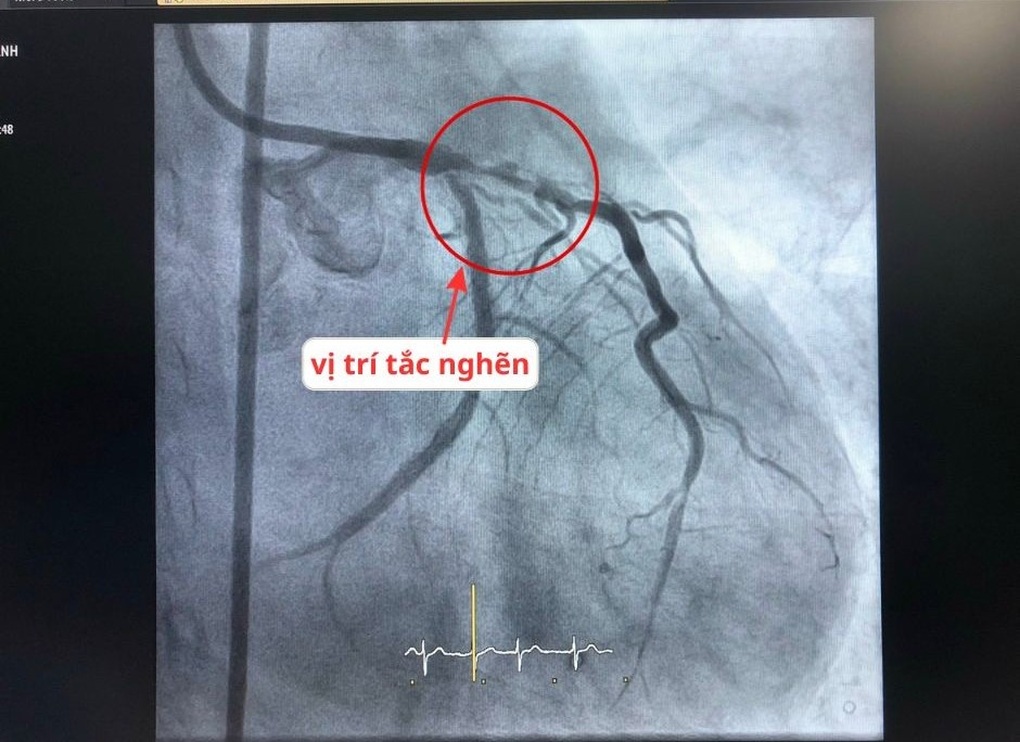 Căng não đặt 2 stent cứu bệnh nhân tái phát hẹp mạch vành tại vị trí khó - 1