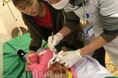 Hai trẻ bị bỏng do dùng củi lửa sưởi ấm trong nhà