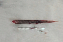 Người đàn ông nguy kịch vì bị đuôi cá đuối đâm thủng phổi