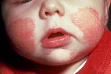 Chăm sóc trẻ bị eczema