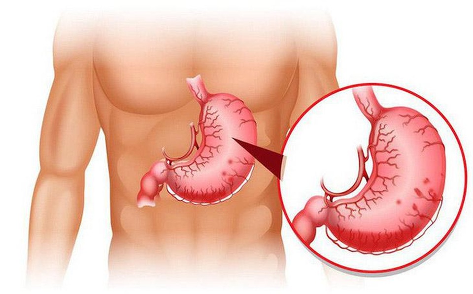Bệnh dạ dày - quả bom nổ chậm cần tháo ngòi nổ kịp thời - 1 Bệnh dạ dày - quả bom nổ chậm cần tháo ngòi nổ kịp thời - 1