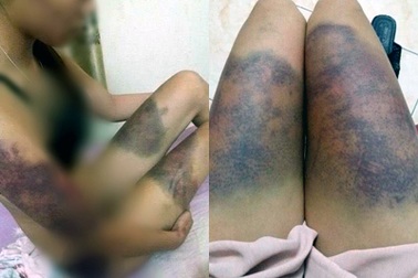 Hà Nội: Điều tra vụ thiếu phụ nghi bị người tình đánh bầm tím người