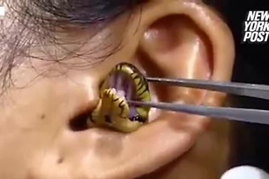 Sốc trước cảnh bác sĩ lôi con rắn còn sống ra khỏi tai người phụ nữ