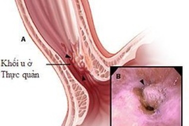 Bệnh trào ngược dạ dày thực quản nguy hiểm hơn bạn biết