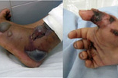 2 trẻ suýt tử vong vì bị rắn cắn