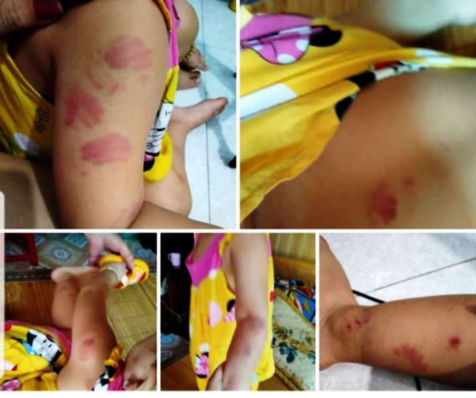 Làm rõ thông tin bé gái 21 tháng tuổi nghi bị cắn nhiều vết khi đến lớp - 1 Làm rõ thông tin bé gái 21 tháng tuổi nghi bị cắn nhiều vết khi đến lớp - 1