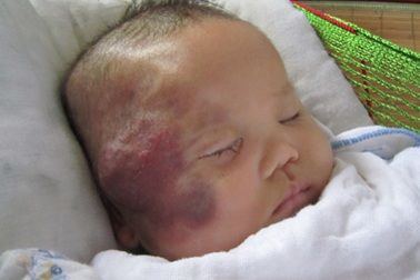 Cầm cự sự sống cho cháu bé 2 tháng tuổi bị u máu trên mặt