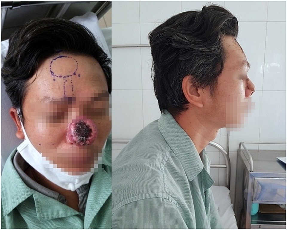Tái tạo mũi mới cho người đàn ông bị khối u ung thư “ăn” mất mũi - 1
