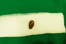 Vượt 200km trong đêm đưa bé gái đi cấp cứu vì… một hạt dưa