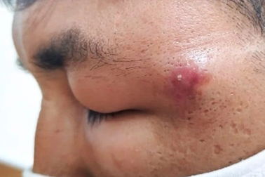 Chàng trai ở TPHCM phù mắt nặng, nguy cơ giảm thị lực chỉ vì một nốt mụn