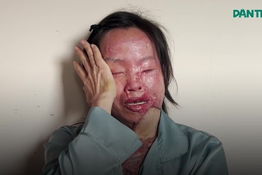 Nỗi đau tận cùng của người phụ nữ bị bỏng axit