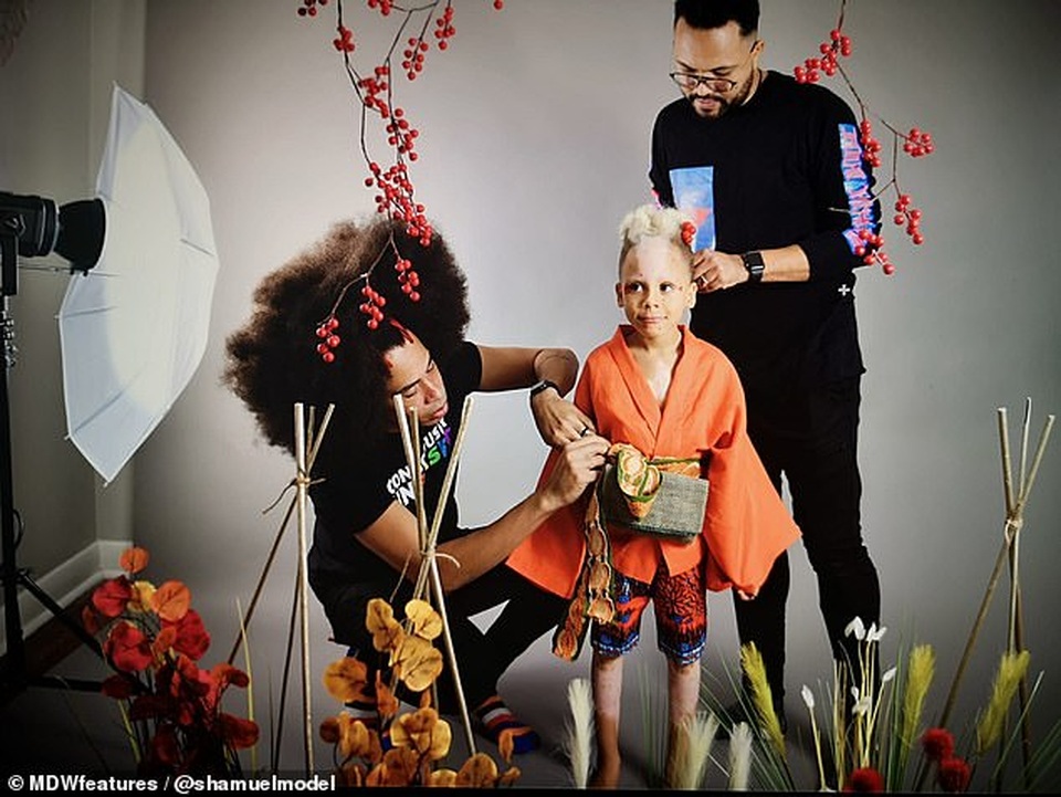 Cậu bé có làn da “như bị bỏng” đắt show trình diễn thời trang - 7 Cậu bé có làn da “như bị bỏng” đắt show trình diễn thời trang - 7