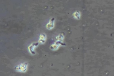 Mỹ ghi nhận 2 ca tử vong vì ký sinh trùng "ăn não"