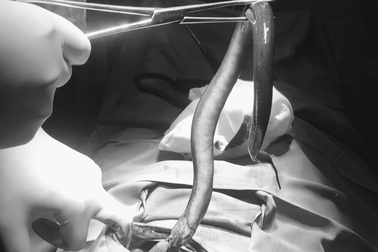 Phát hiện con lươn dài 30cm trong ổ bụng người đàn ông