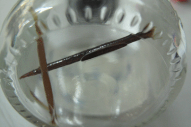 Mổ ruột thừa, điều trị gần 2 tháng vì nuốt phải tăm nhọn