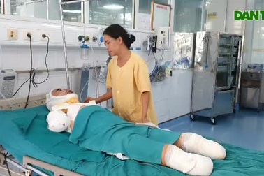 Nhói lòng nhìn người bố 3 con phải cắt cụt tay chân vì bỏng điện