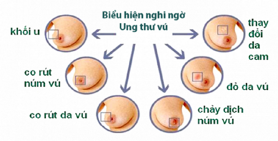 Những thực phẩm giúp ngăn ngừa ung thư vú - 1 Những thực phẩm giúp ngăn ngừa ung thư vú - 1