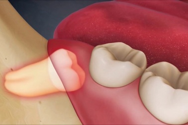 Răng số 8 biến chứng có thể là vấn đề của … ung thư