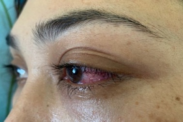 Tưởng đau mắt đỏ, bệnh nhân suýt mù vì bệnh lý hiếm gặp